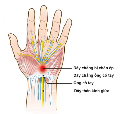 Đau khớp cổ tay: Là biểu hiện của bệnh gì?