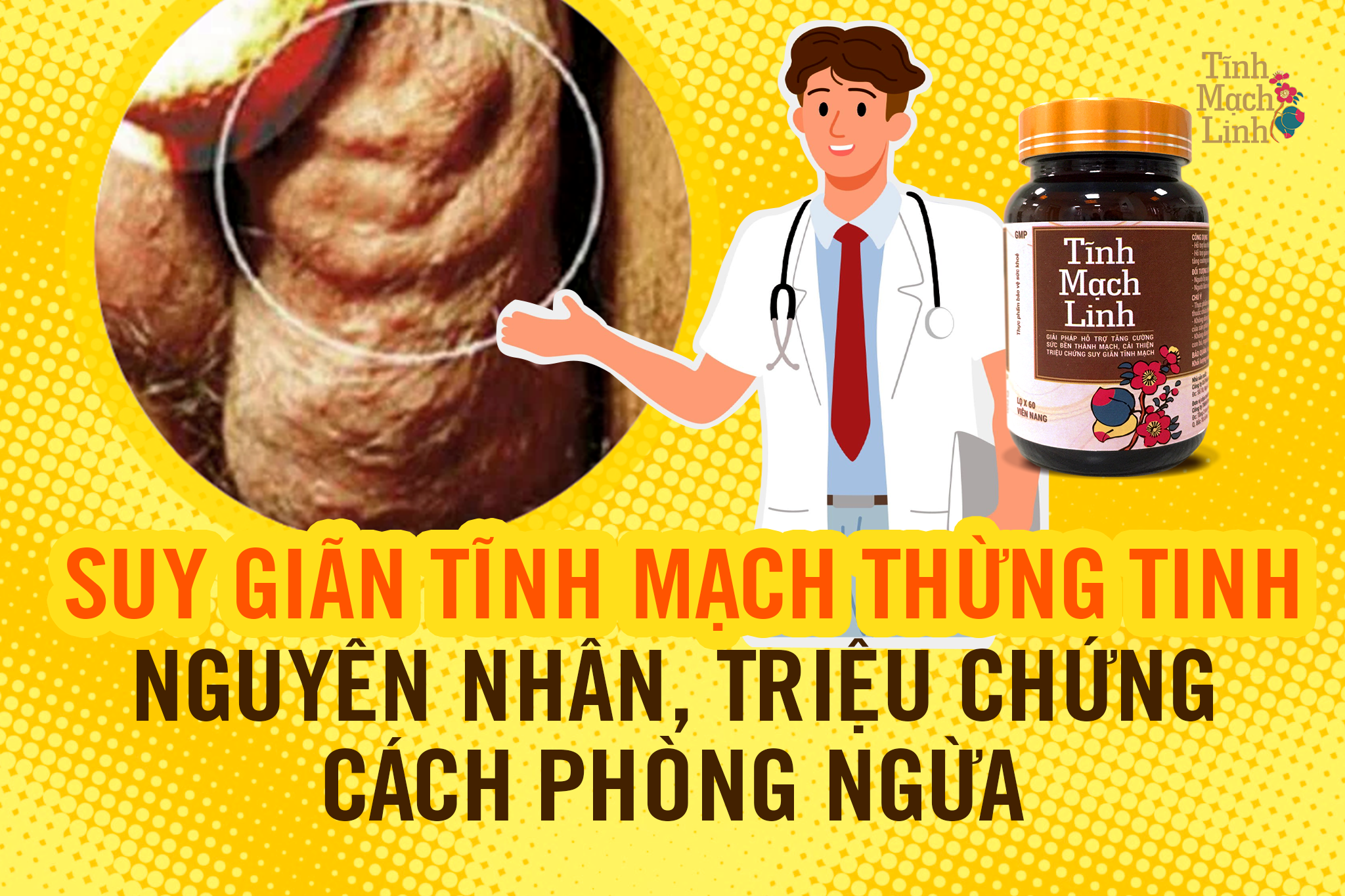 Suy giãn tĩnh mạch thừng tinh: Nguyên nhân, triệu chứng, cách phòng ngừa
