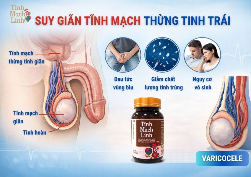Suy giãn tĩnh mạch thừng tinh trái: Nguyên nhân, dấu hiệu và giải pháp cải thiện hiệu quả