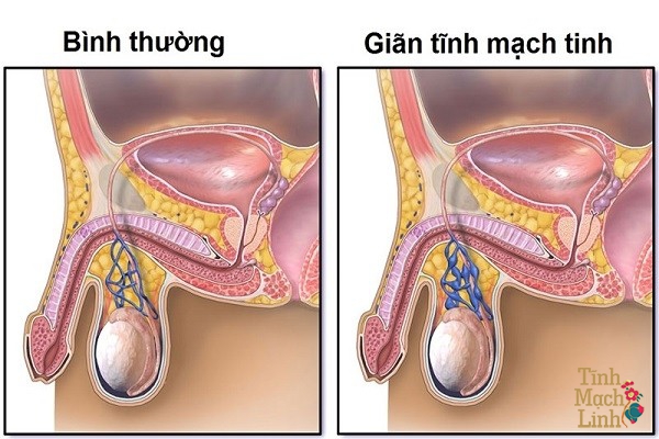 gian-tinh-mach-thung-tinh-1