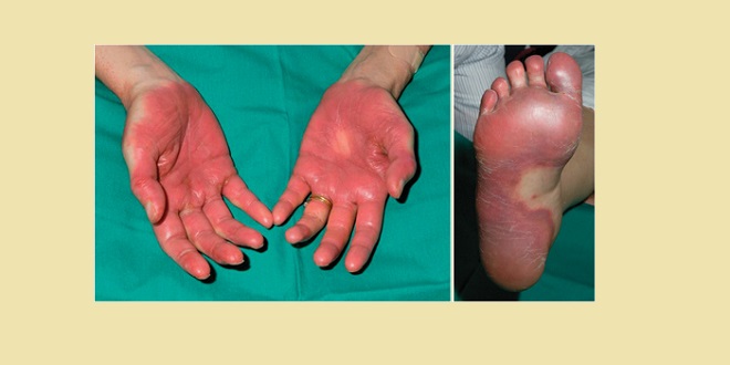 7 bí quyết ngăn ngừa hội chứng bàn tay – chân trong điều trị ung thư