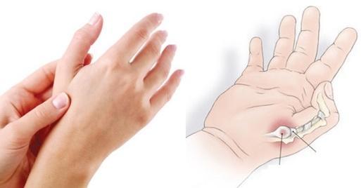 Đau khớp ngón tay cái: Biểu hiện của hội chứng ống cổ tay