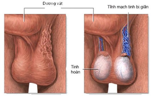 Thắt tĩnh mạch thừng tinh: Tăng khả năng thụ tinh cho bệnh nhân vô sinh nam