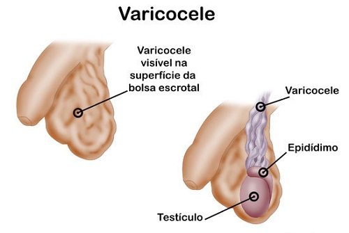 Varicocele là bệnh gì? Có ảnh hưởng đến khả năng sinh sản không?