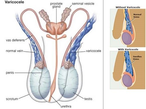 Giải đáp một số thắc mắc về giãn tĩnh mạch thừng tinh