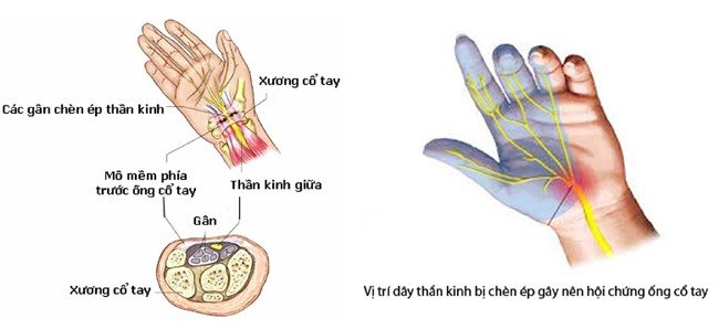 Kĩ thuật mổ Hội chứng ống cổ tay: Những điều cần lưu ý 