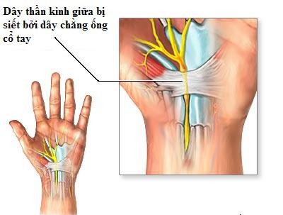 Tê tay trái là dấu hiệu của bệnh gì? Nguyên nhân và cách khắc phục