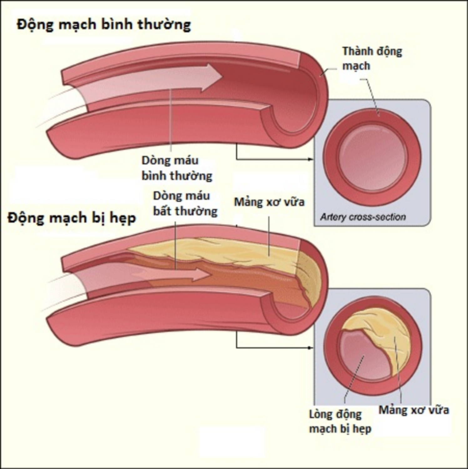 Bệnh xơ vữa động mạch ngoại biên chi dưới: Biến chứng thiếu máu chi dưới gây cắt cụt chi
