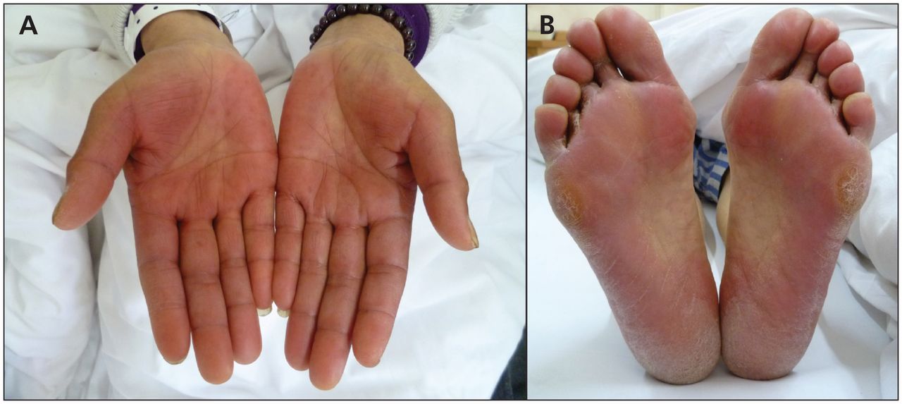 Làm thế nào để giảm hội chứng bàn tay – chân trong điều trị ung thư?