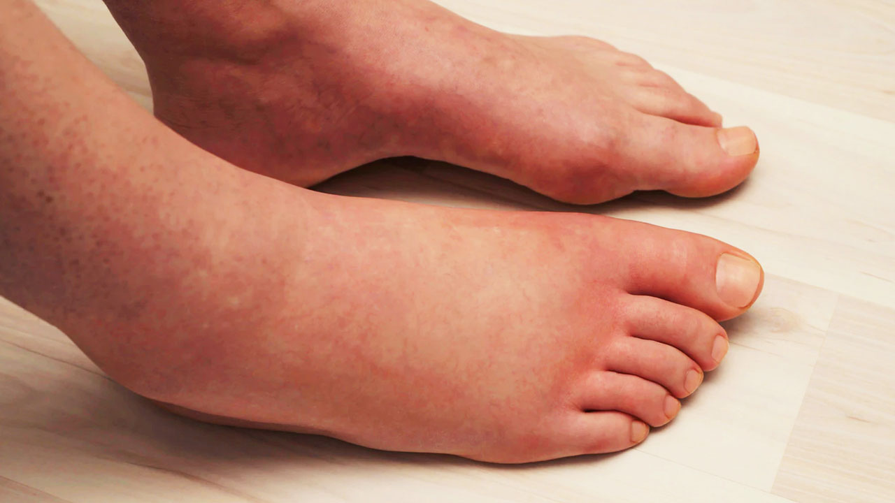 Hướng dẫn chăm sóc đôi chân cho người mắc viêm tắc tĩnh mạch chi dưới