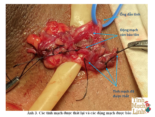 Bí quyết chăm sóc sau mổ giãn tĩnh mạch thừng tinh