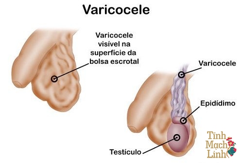 bệnh Varicocele; giãn tĩnh mạch thừng tinh 