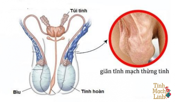 Điều trị vô sinh do giãn tĩnh mạch thừng tinh