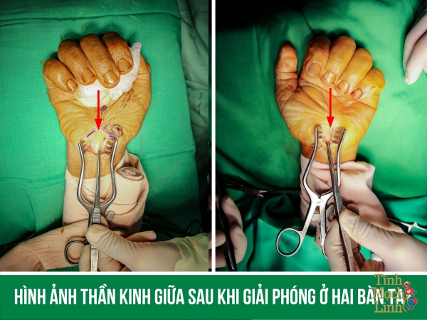 Mổ hội chứng ống cổ tay 