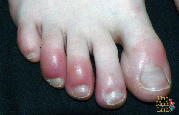 Tê ngón chân cái: Tổng hợp nguyên nhân và cách điều trị