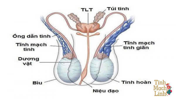 Giãn tĩnh mạch thừng tinh 2 bên