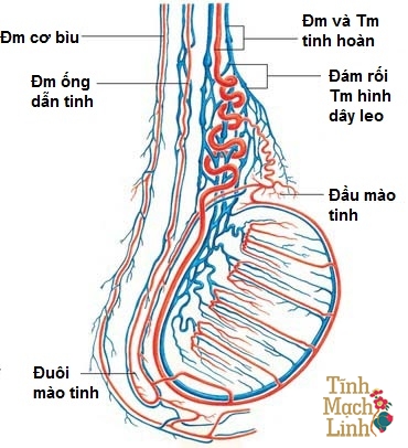 Giãn tĩnh mạch tinh hoàn có gây vô sinh không?