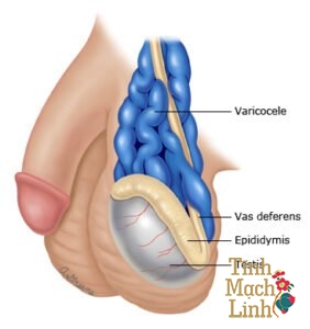 Giãn tĩnh mạch thừng tinh độ 1