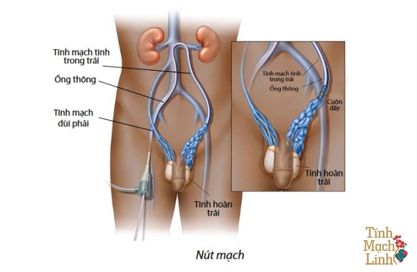 Nguyên nhân gây giãn tĩnh mạch thừng tinh