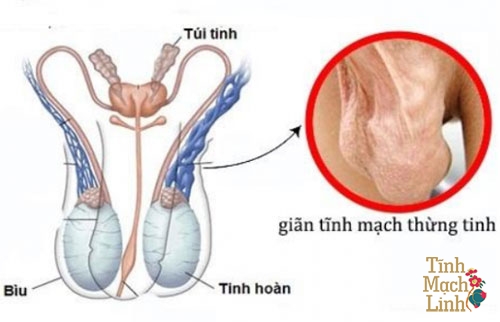 Giãn tĩnh mạch tinh hoàn