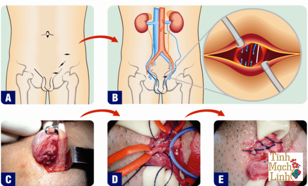 Phương pháp điều trị giãn tĩnh mạch thừng tinh