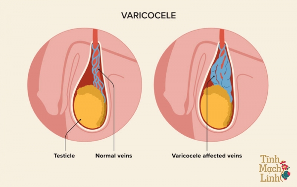 Biến chứng giãn tĩnh mạch thừng tinh 