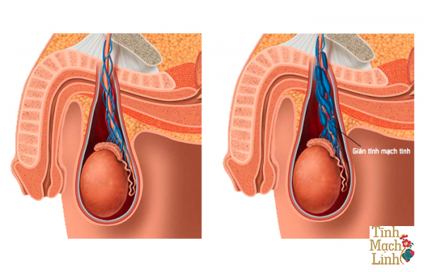Giãn tĩnh mạch  tinh hoàn bên trái 