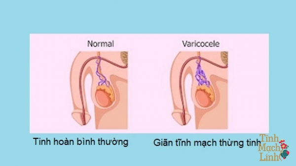 Giãn thừng tinh hoàn 