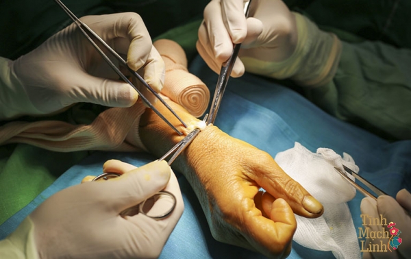 Tiểu phẫu hội chứng ống cổ tay