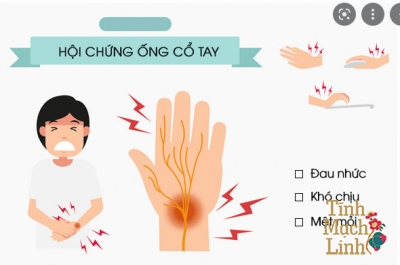 Top 7 cách điều trị hội chứng ống cổ tay đơn giản nhất