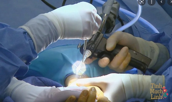 Chi phí phẫu thuật hội chứng ống cổ tay