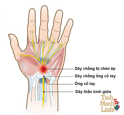 Tê ngón tay, bàn tay do hội chứng ống cổ tay phải làm sao?