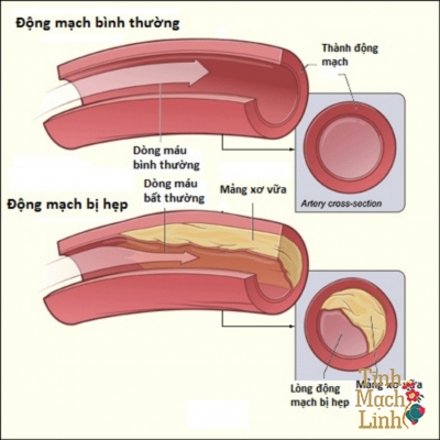 Bệnh xơ vữa động mạch ngoại biên chi dưới: Biến chứng thiếu máu chi dưới gây cắt cụt chi