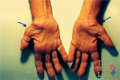 Mách bạn 10 cách khắc phục hội chứng ống cổ tay tại nhà siêu hiệu quả