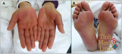 Làm thế nào để giảm hội chứng bàn tay – chân trong điều trị ung thư?