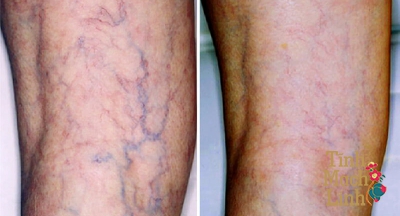 Phân biệt bệnh lý viêm tắc tĩnh mạch nông và suy giãn tĩnh mạch